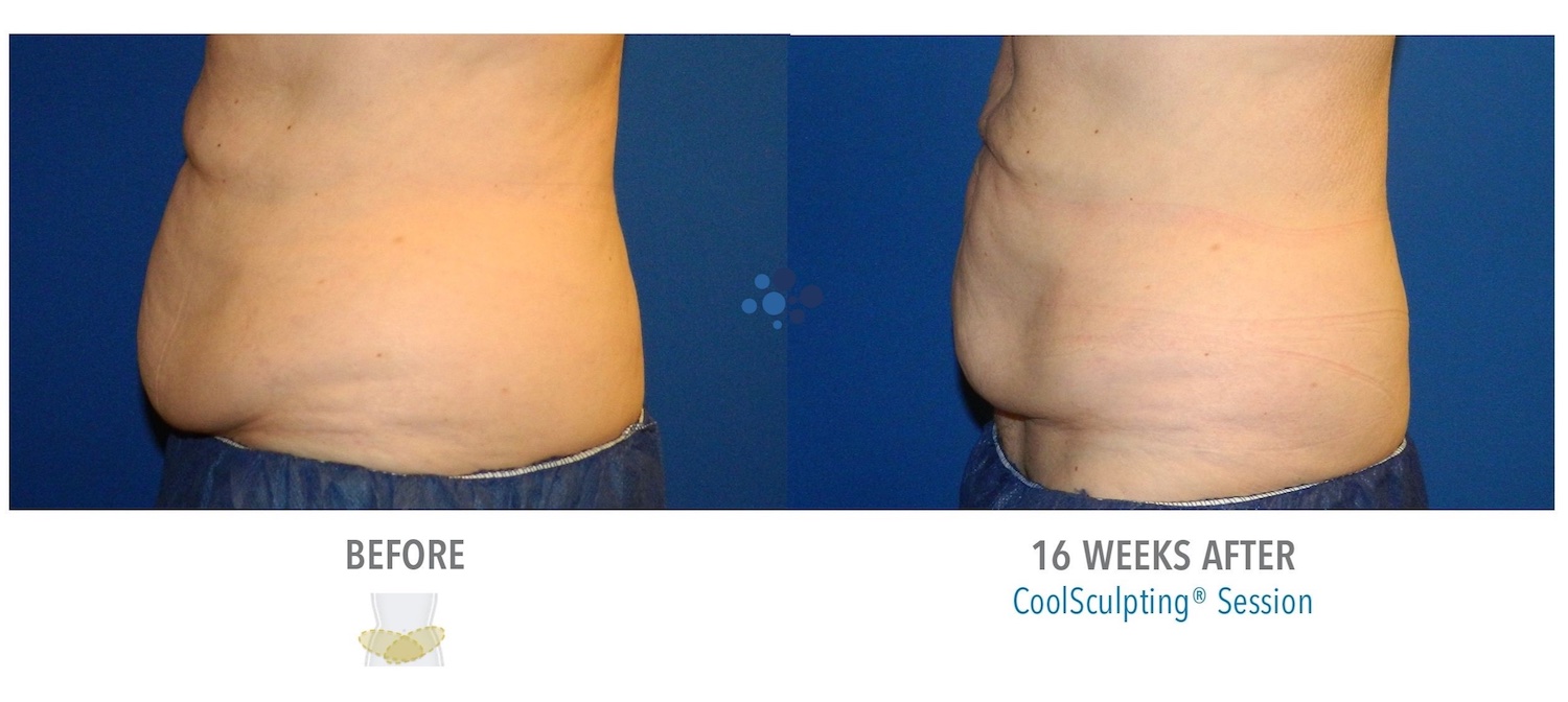 CoolSculpting Abdomen Female - Before and After