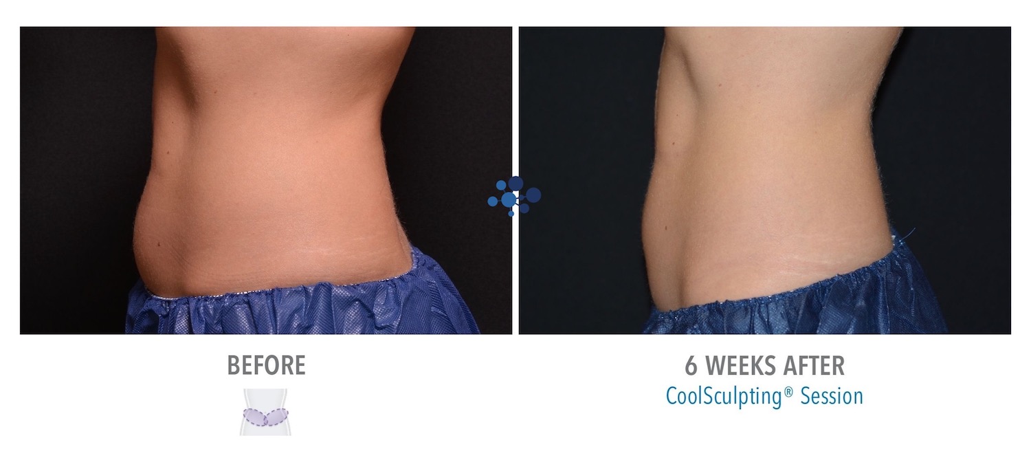 CoolSculpting Before and After Picture of Back Fat and Stomach