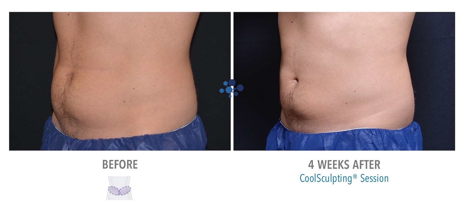 CoolSculpting - Before & After