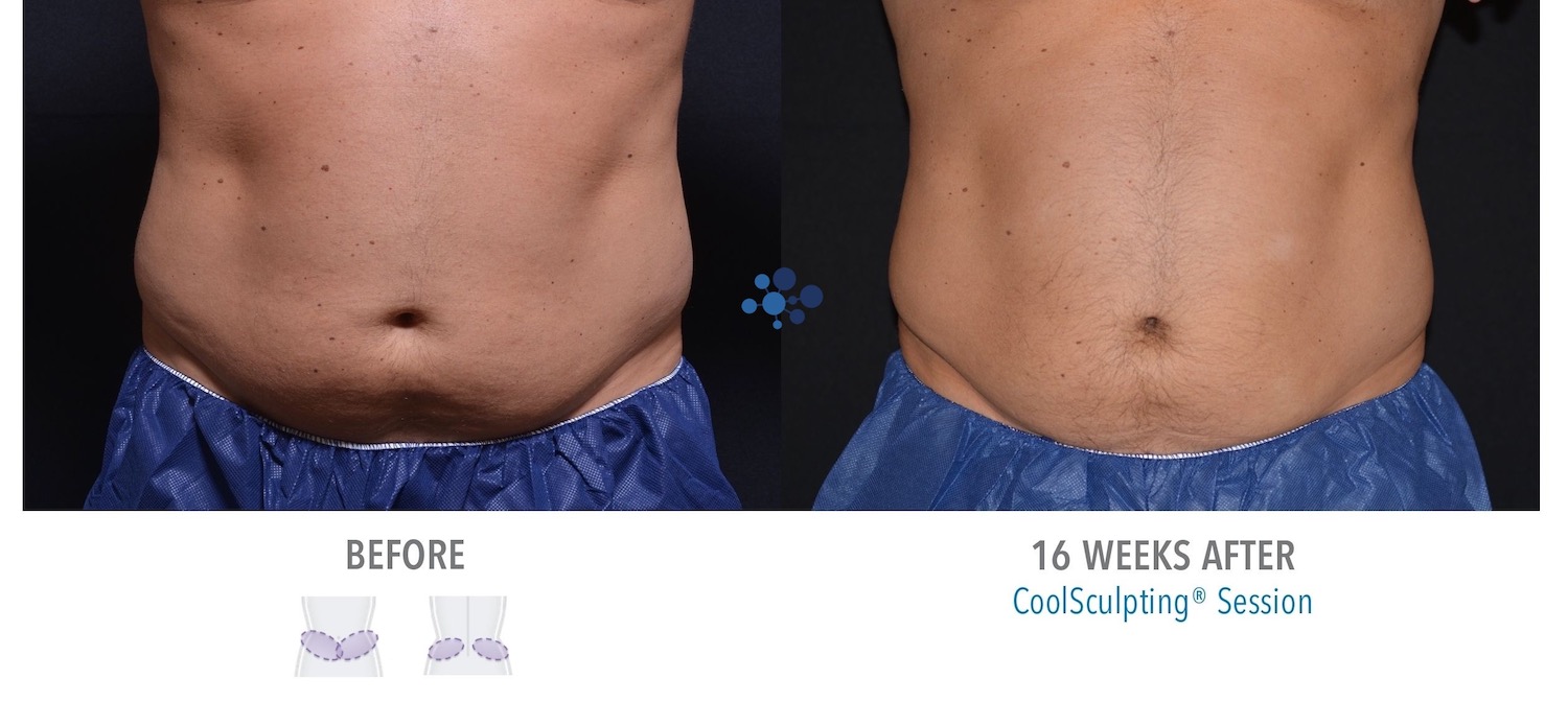 CoolSculpting Abdomen Male - Before and After