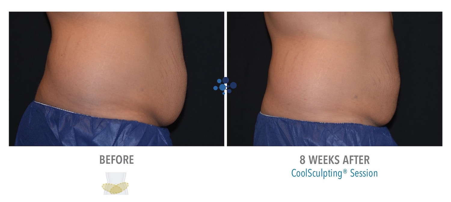 CoolSculpting Abdomen Male - Before and After