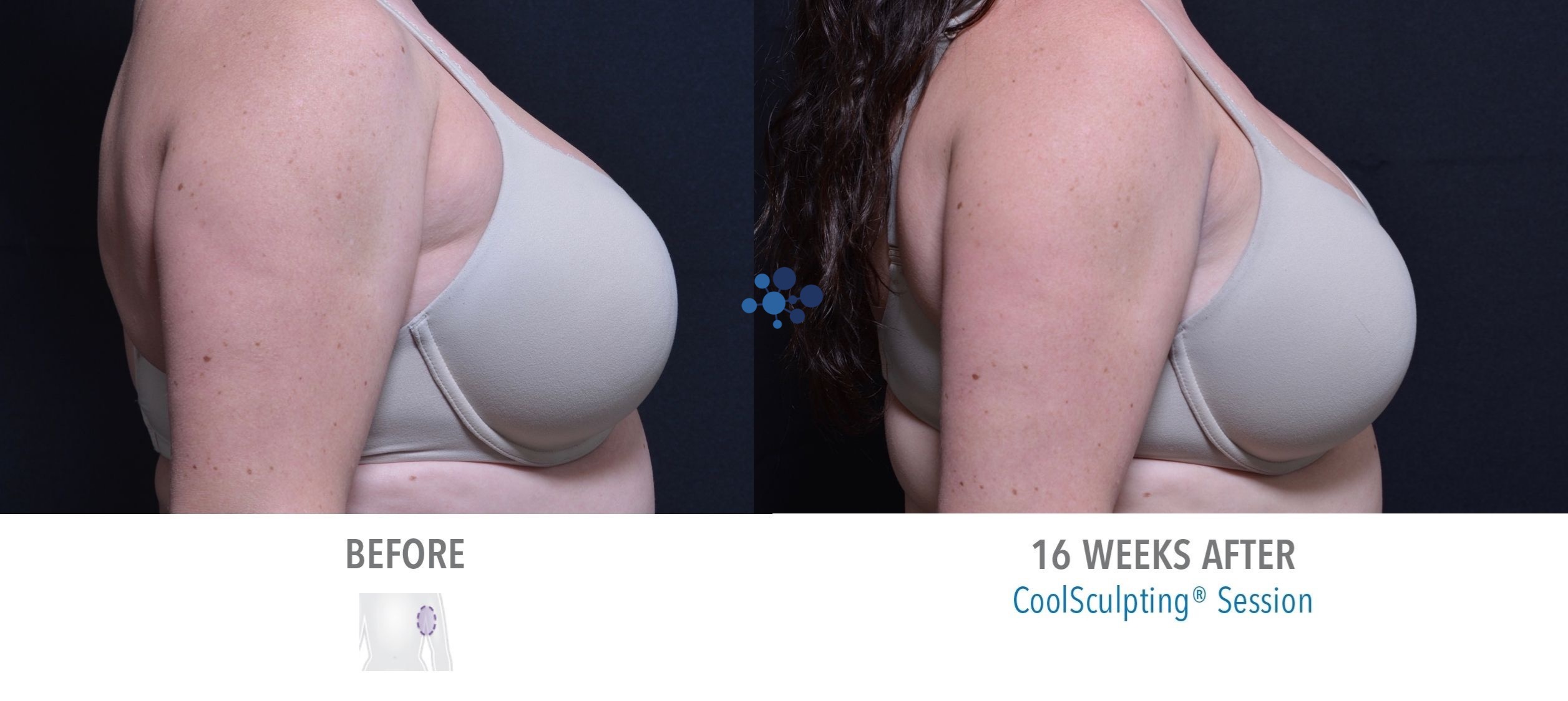 CoolSculpting Auxiliary Puff Female - Before and After