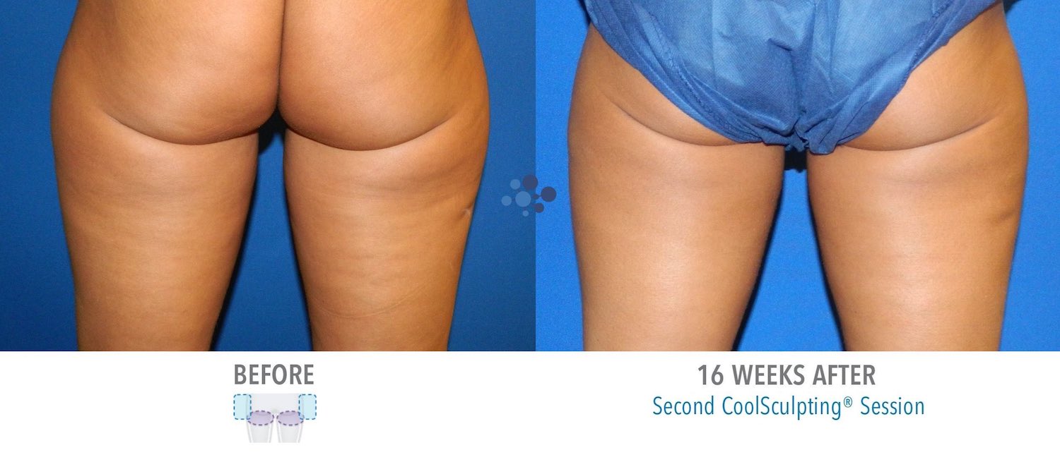 CoolSculpting Banana Female - Before and After