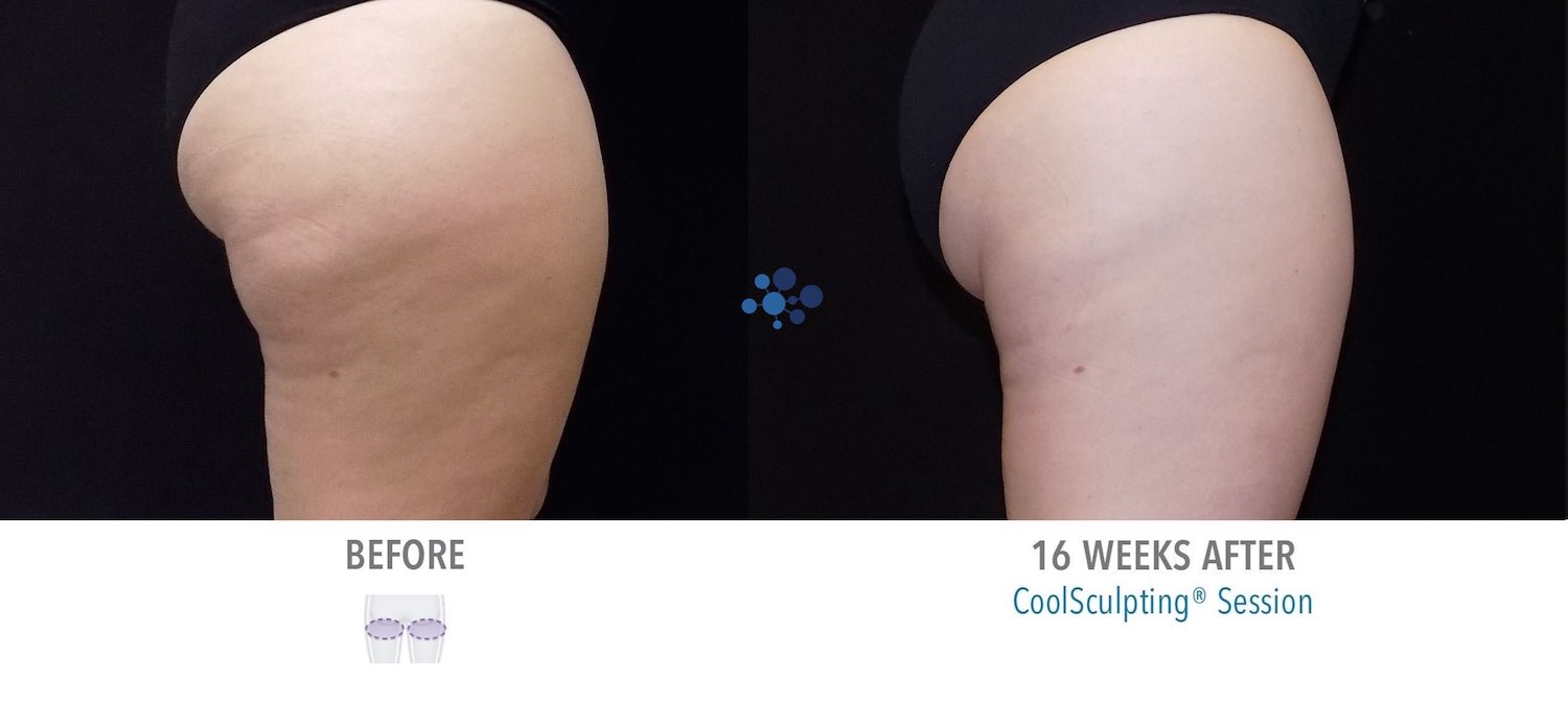 CoolSculpting Banana Female - Before and After