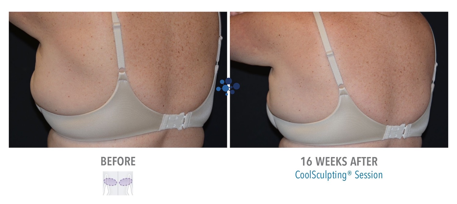 CoolSculpting Bra Line Female - Before and After
