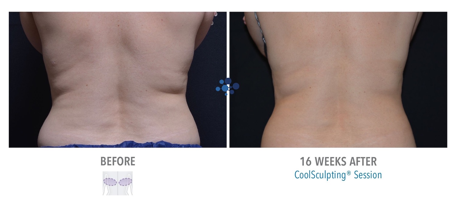 CoolSculpting Bra Line Female - Before and After