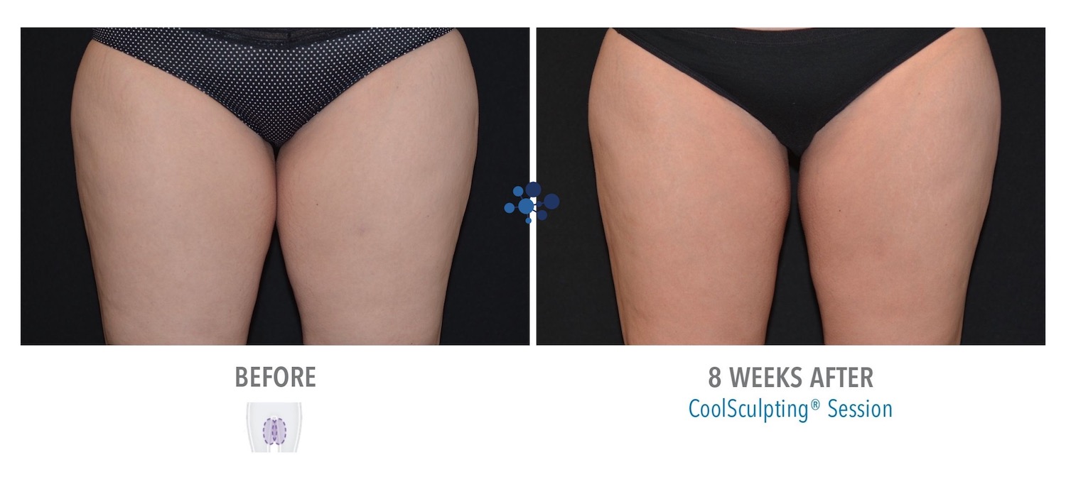 CoolSculpting Inner Thighs Female - Before and After