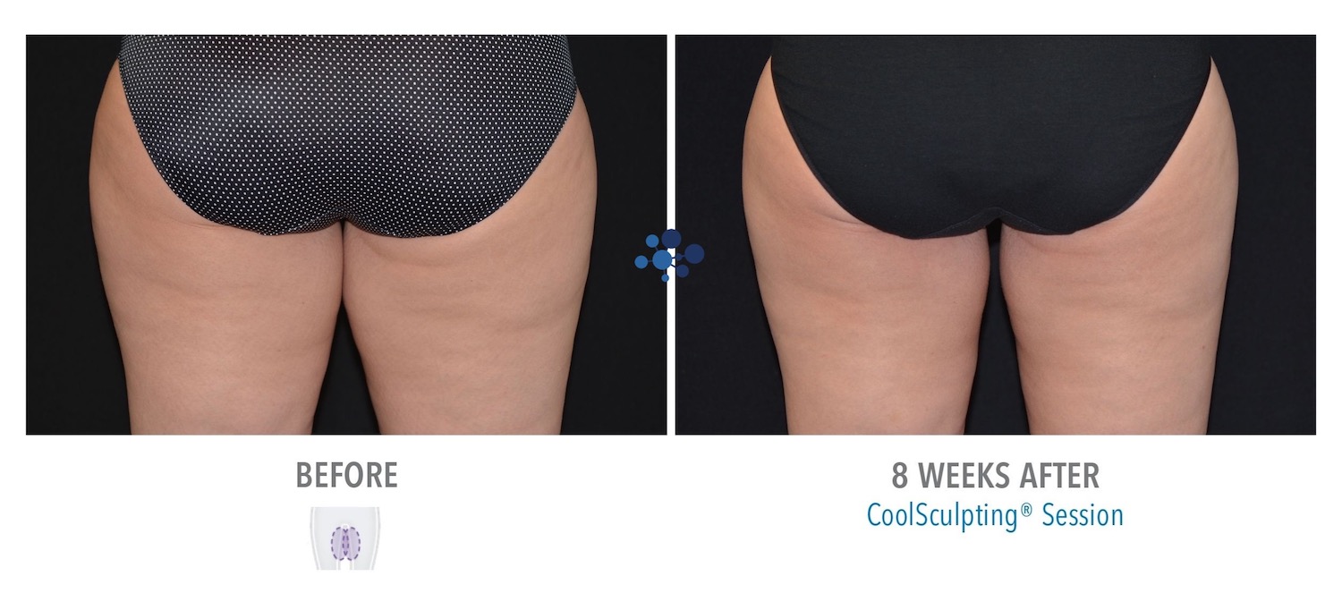 CoolSculpting Inner Thighs Female - Before and After