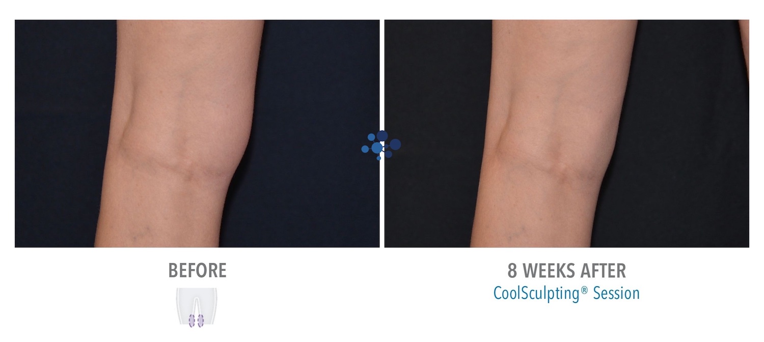 CoolSculpting Knees - Before and After