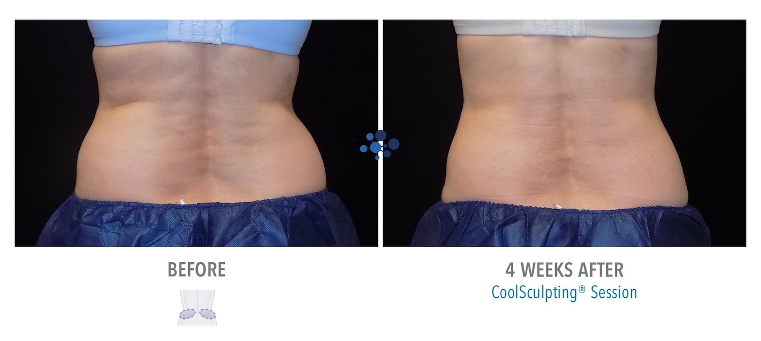CoolSculpting Love Handles Female - Before and After