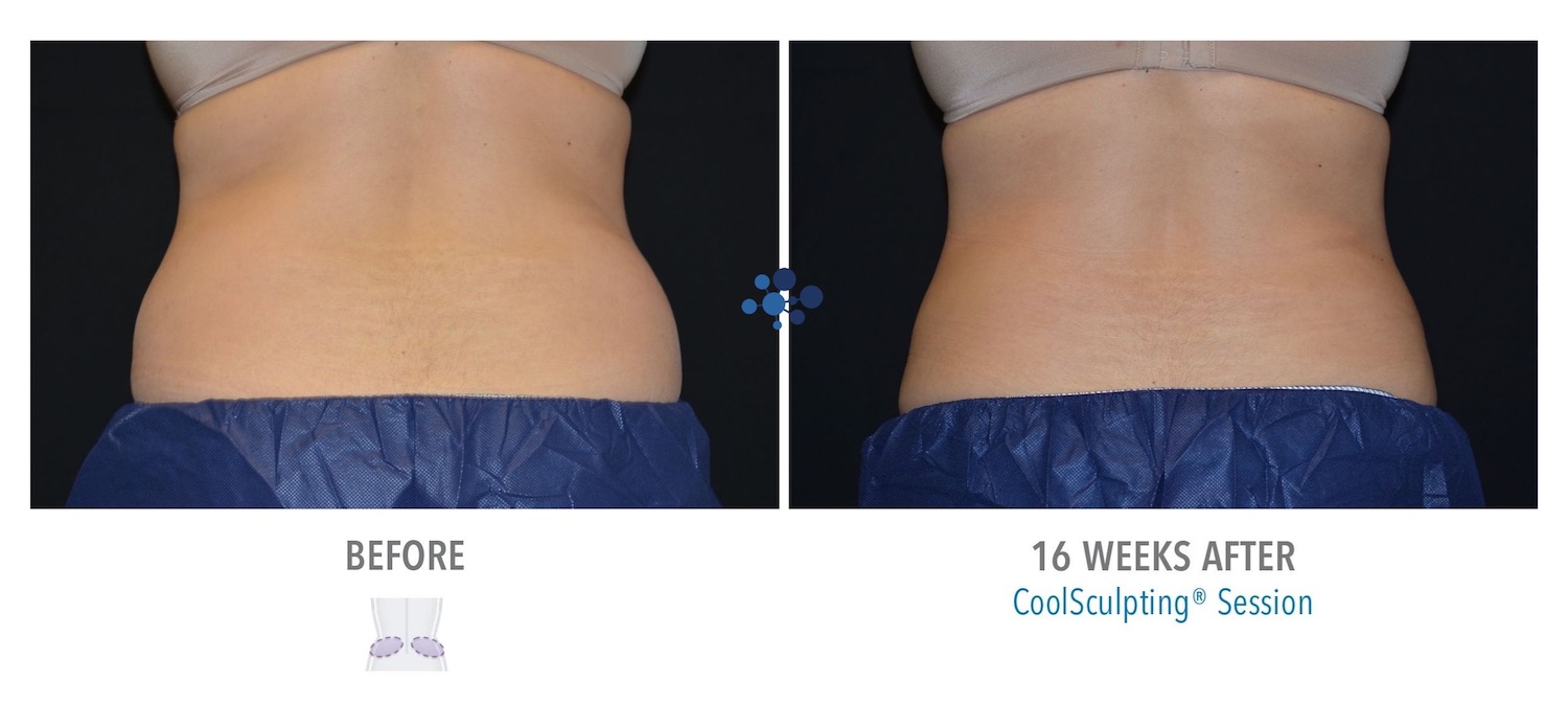 CoolSculpting Love Handles Female - Before and After