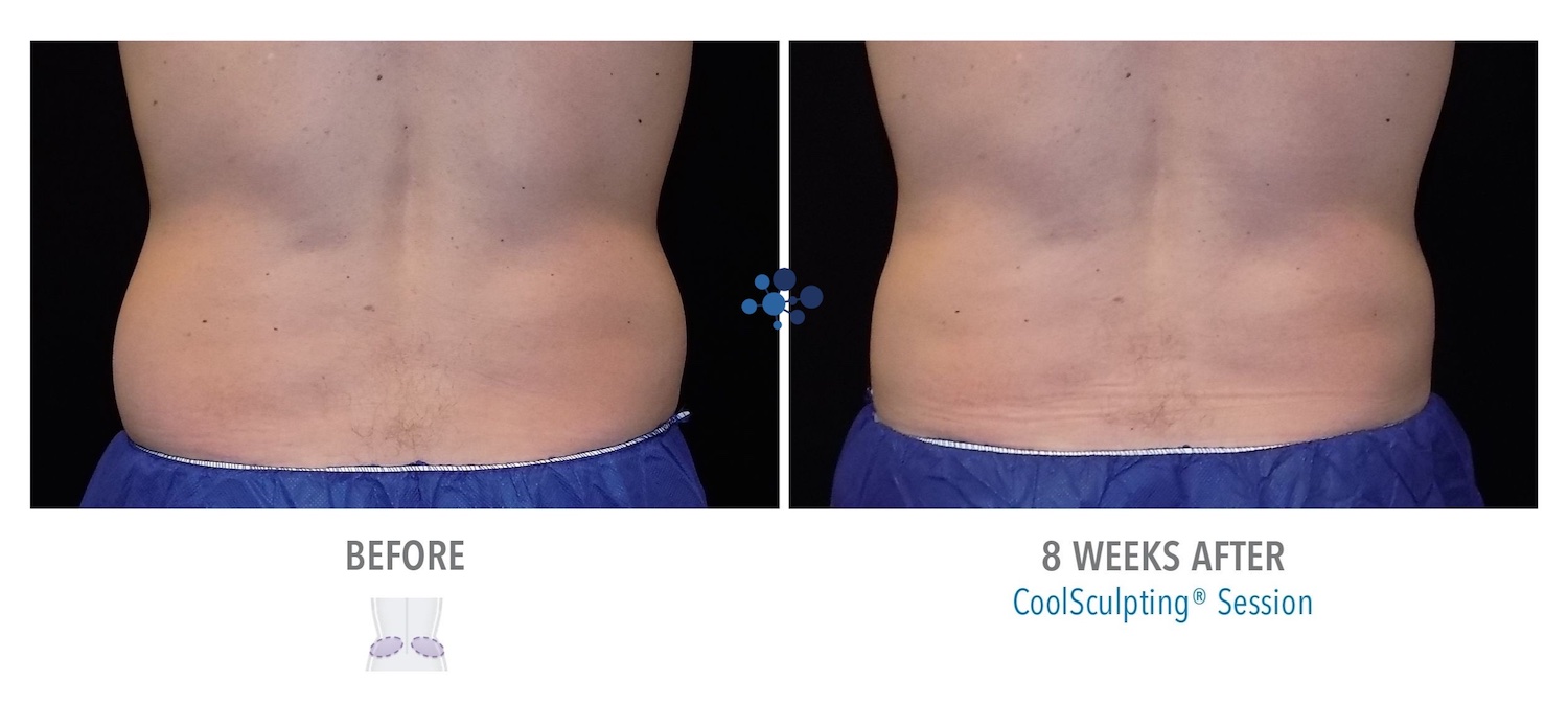 CoolSculpting Love Handles Male - Before and After