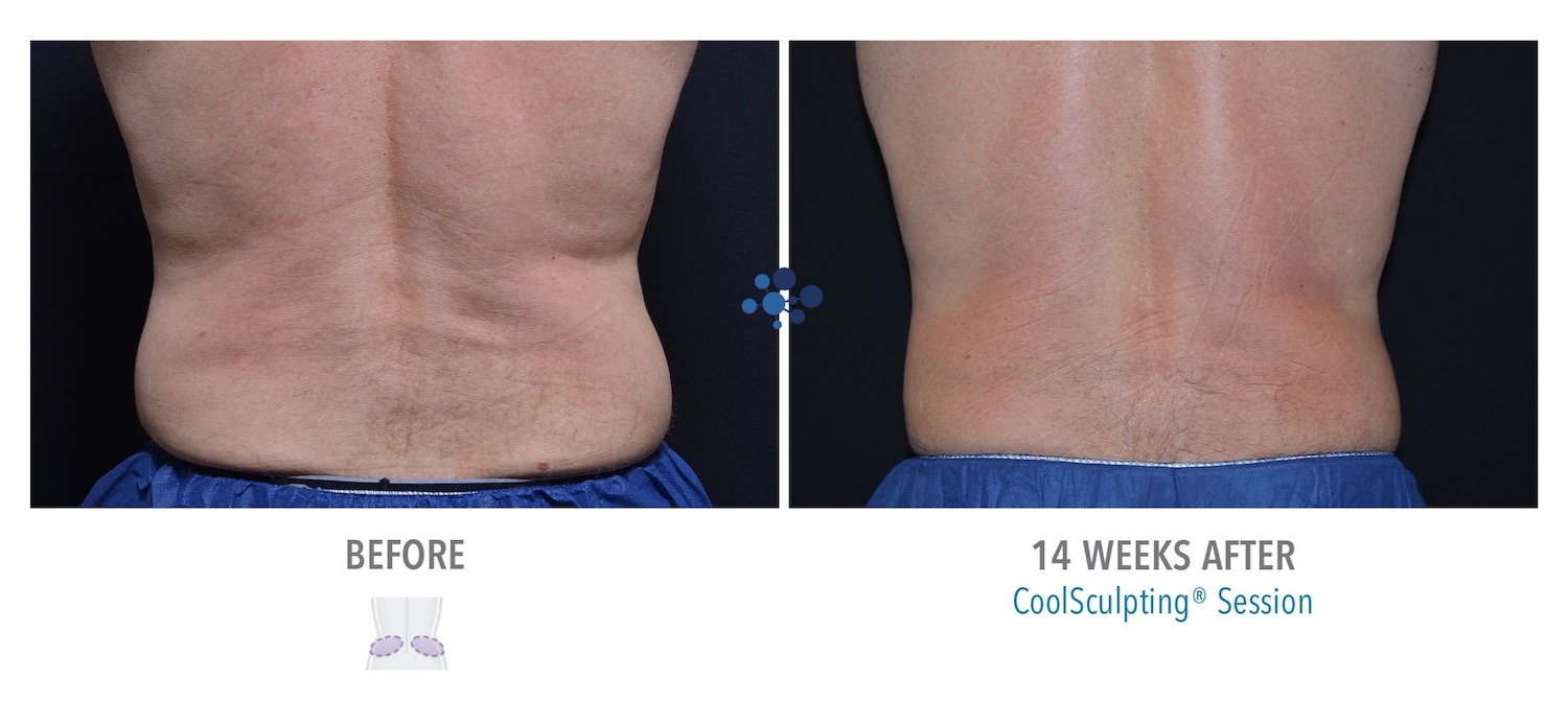 CoolSculpting Love Handles Male - Before and After