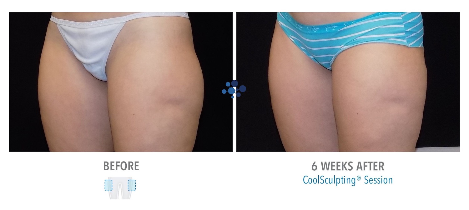 CoolSculpting Outer Thighs Female - Before and After