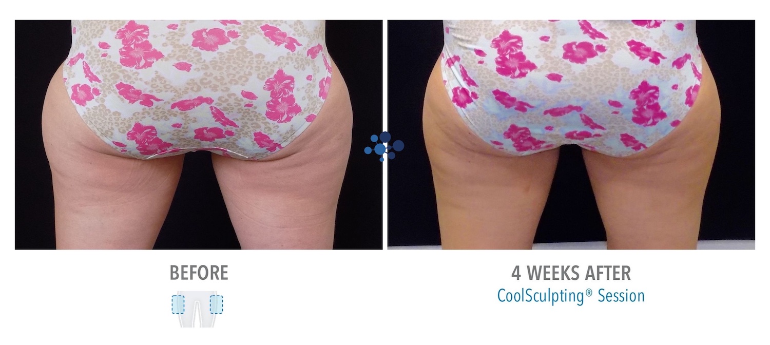 CoolSculpting Outer Thighs Female - Before and After