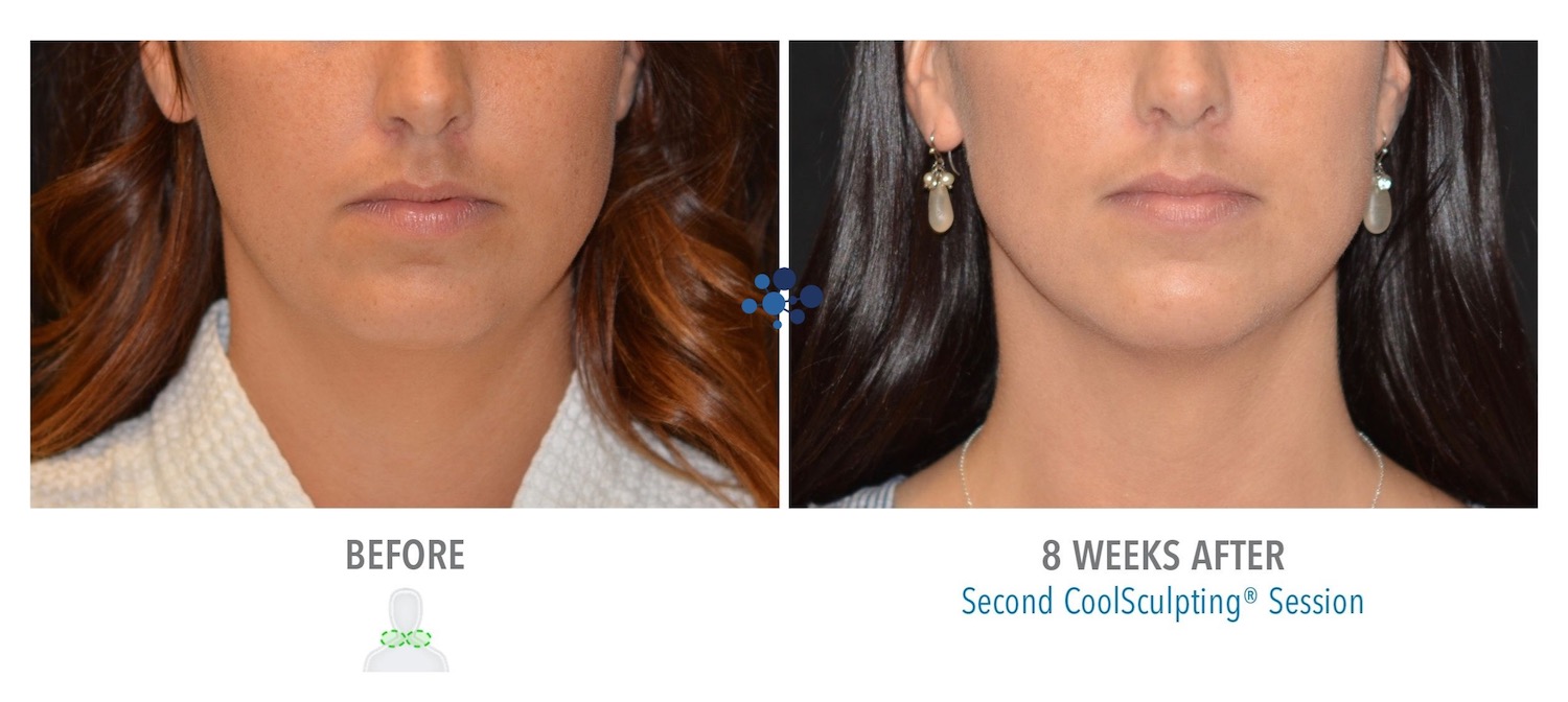 CoolSculpting Submental Female - Before and After