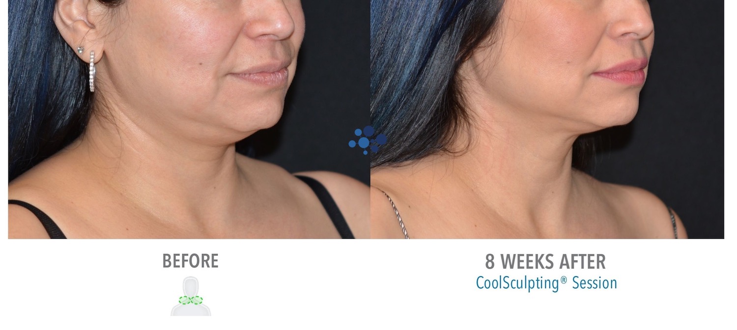 CoolSculpting Submental Female - Before and After