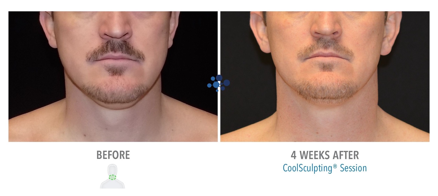 CoolSculpting Submental Male - Before and After