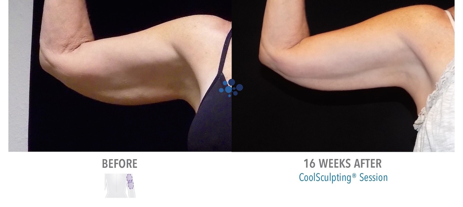 CoolSculpting Upper Arms Female - Before and After