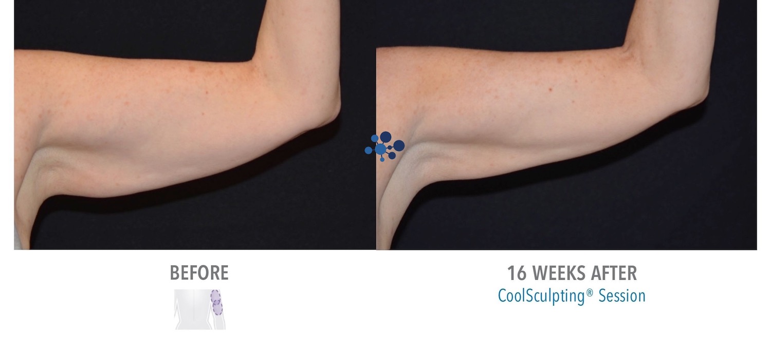 CoolSculpting Upper Arms Female - Before and After