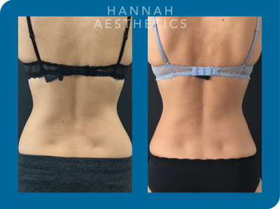 CoolSculpting to flanks -3 months after treatment