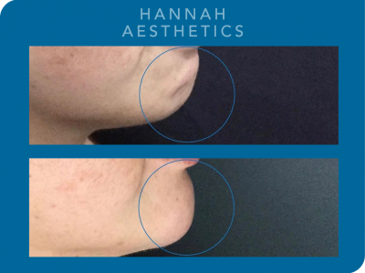Chin Augmentation - 1ml dermal filler Immediately after treatment