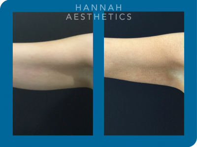 CoolSculpting to arms - 1 cycle 3 months after treatment