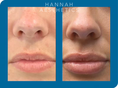 Lip enhancement 2 weeks after treatment